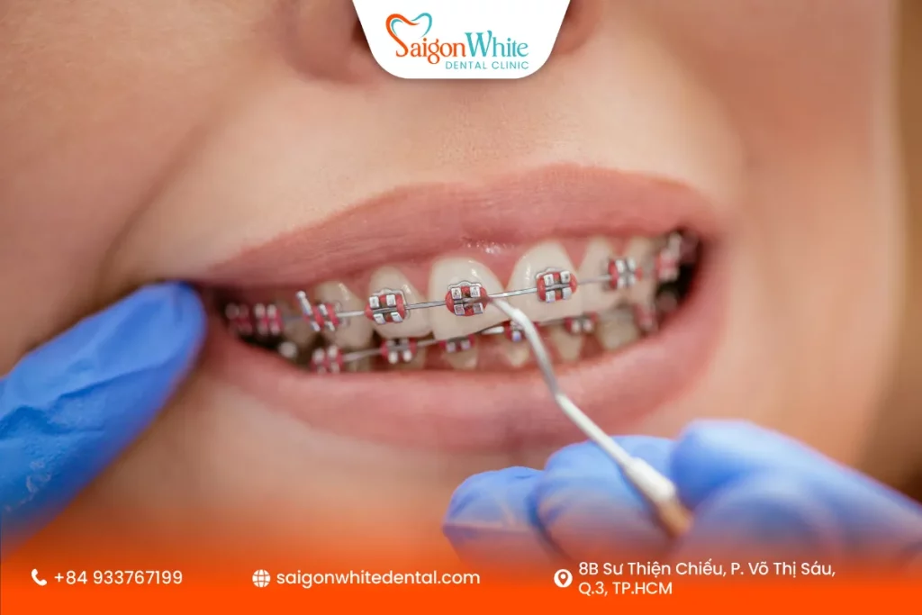 Thời gian và chi phí niềng răng sau 30 tuổi