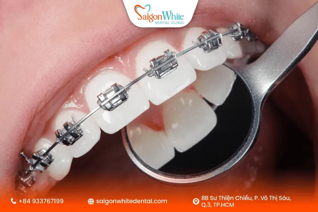 Lời khuyên ăn uống và chăm sóc răng miệng khi niềng răng