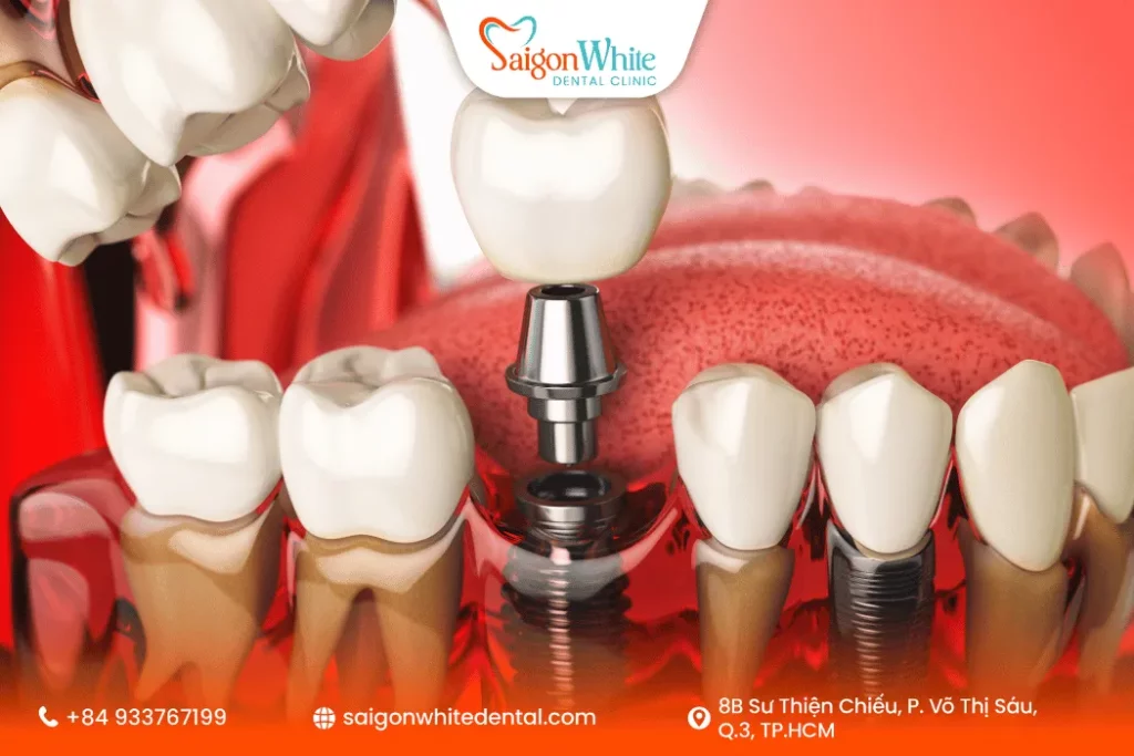 Các yếu tố ảnh hưởng đến chi phí trụ Implant Đức