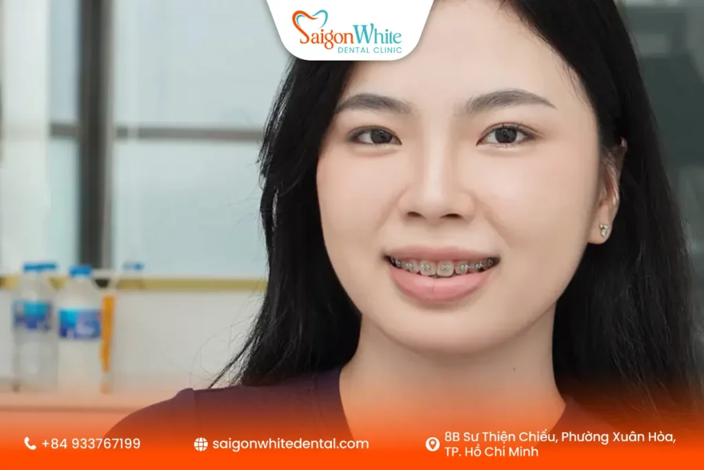 Ưu điểm khi niềng răng 18 tuổi