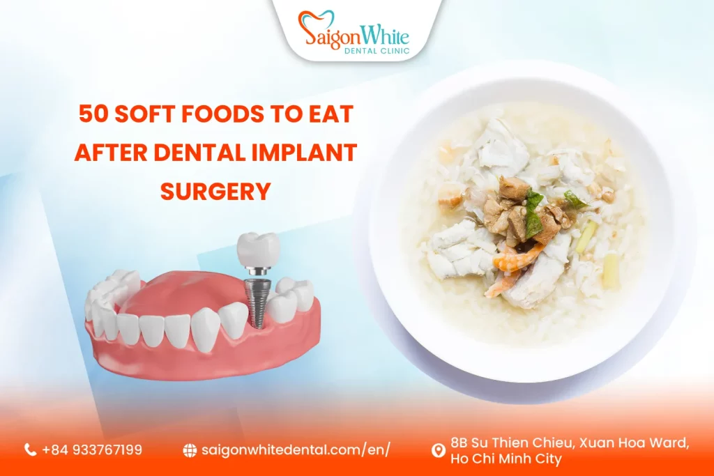50 Soft Foods To Eat After Dental Implant Surgery
