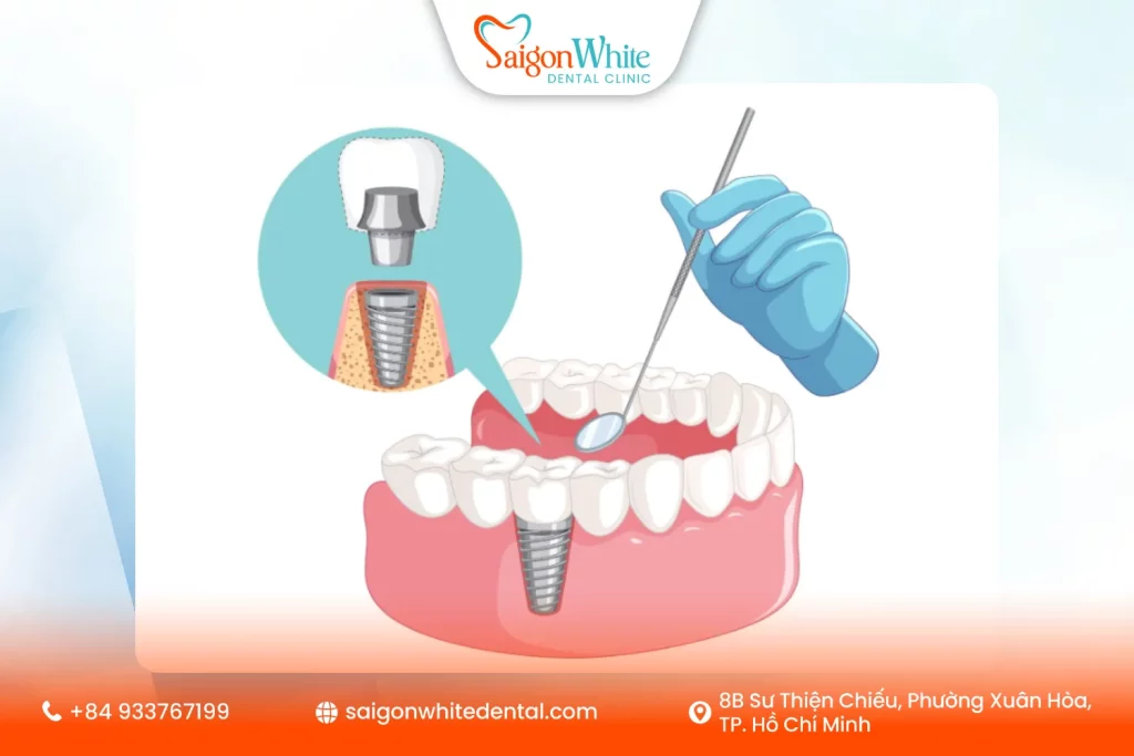 Khớp nối (Abutment) dùng để làm gì?