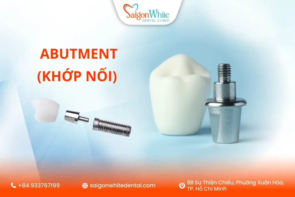 Abutment (Khớp nối) trong Nha khoa là gì ?