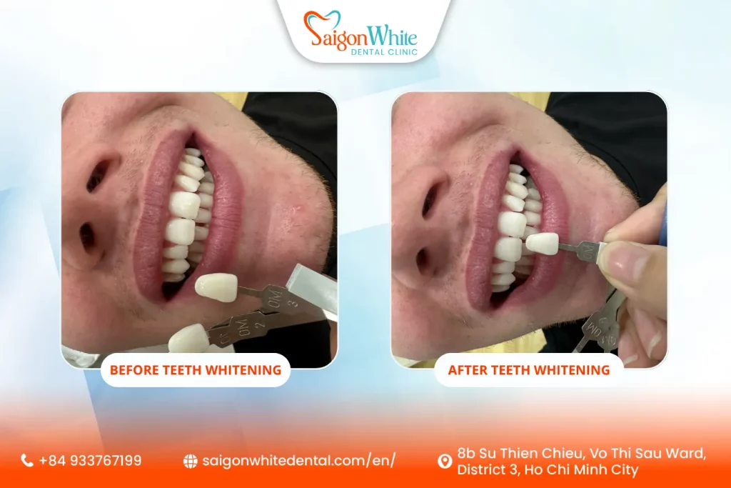 Before After Teeth Whitening in ho chi minh city vietnam
