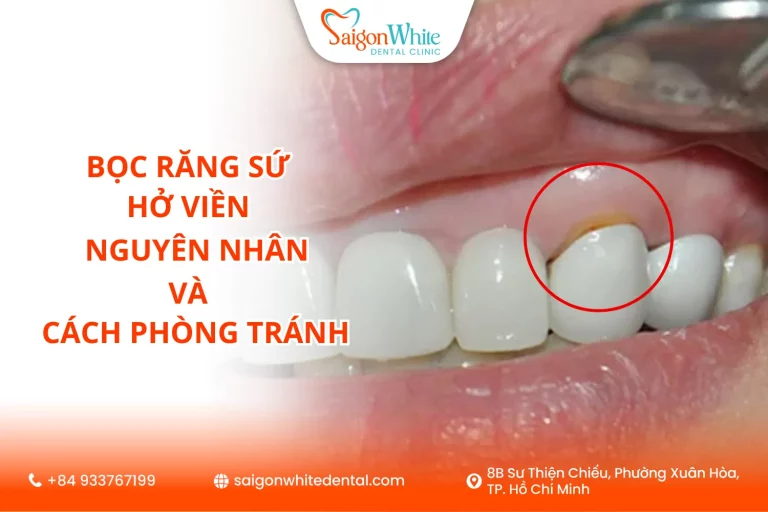 Bọc răng sứ hở viền – Nguyên nhân và cách phòng tránh