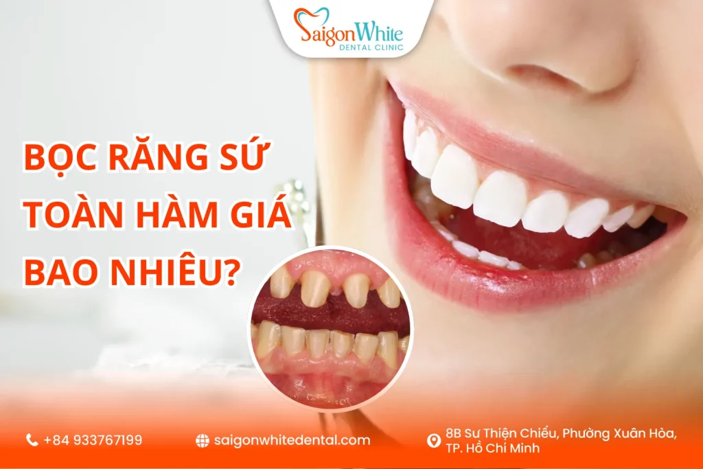 Bọc răng sứ toàn hàm giá bao nhiêu?