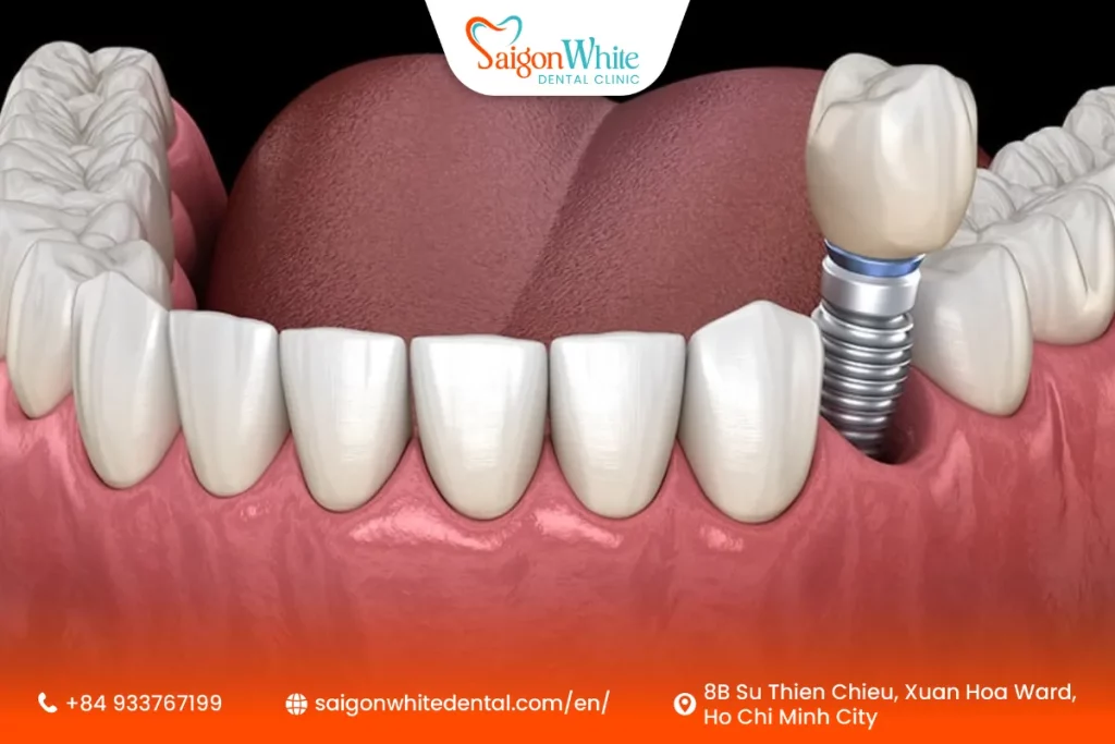 Common Causes of a Loose Dental Implant