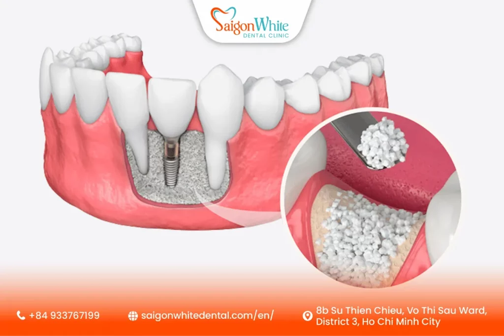 Dental Bone Graft in Ho Chi Minh City
