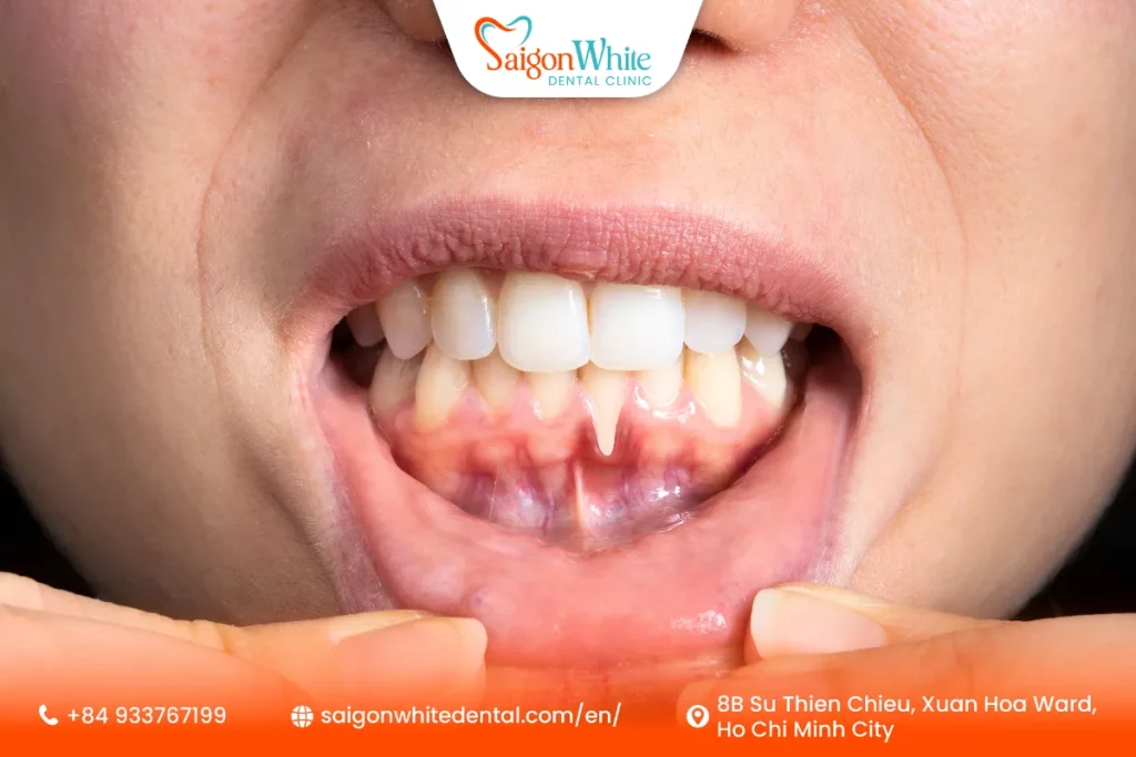 A Patient has Periodontal
