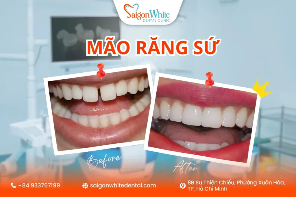Mão răng sứ giải pháp phục hình răng tối ưu
