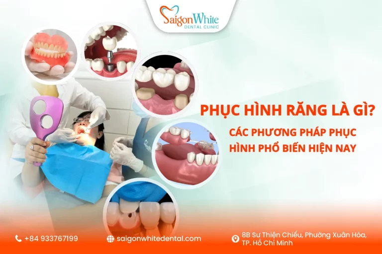 Phục hình răng là gì? Các phương pháp phục hình