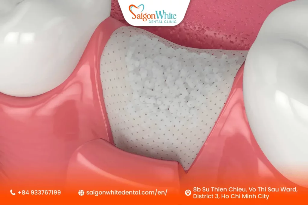 Recovery and essential aftercare for your Bone Graft