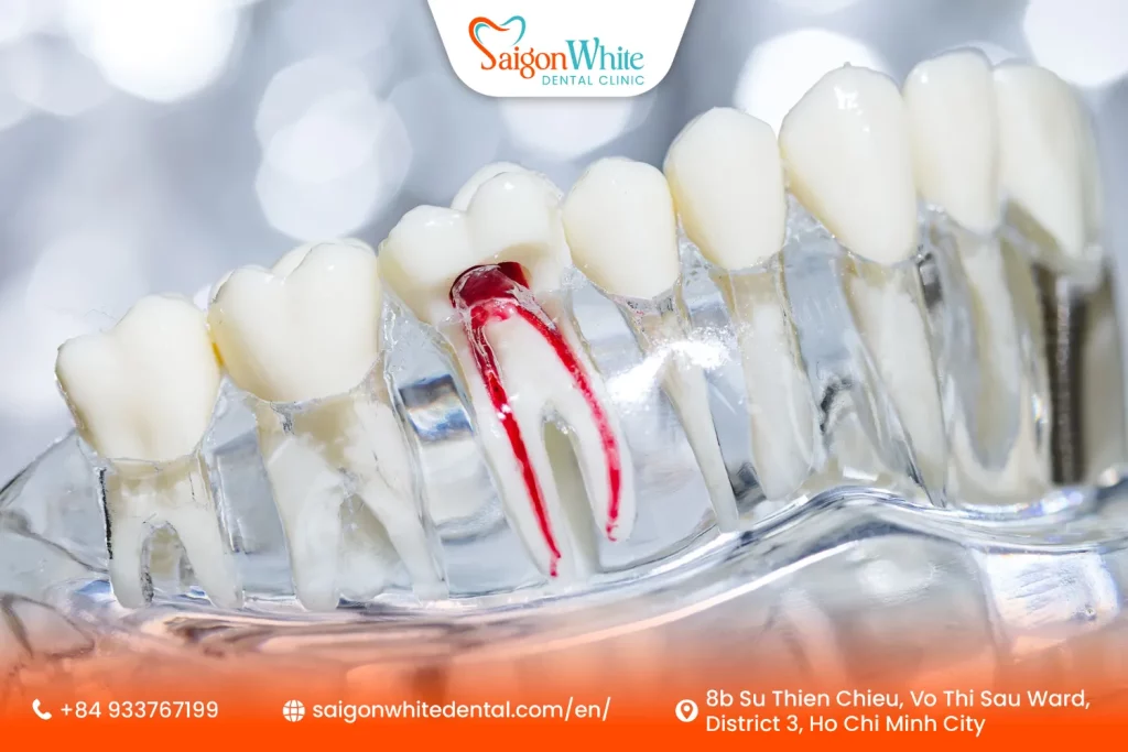 Root Canal Treatment in Ho Chi Minh City, Vietnam