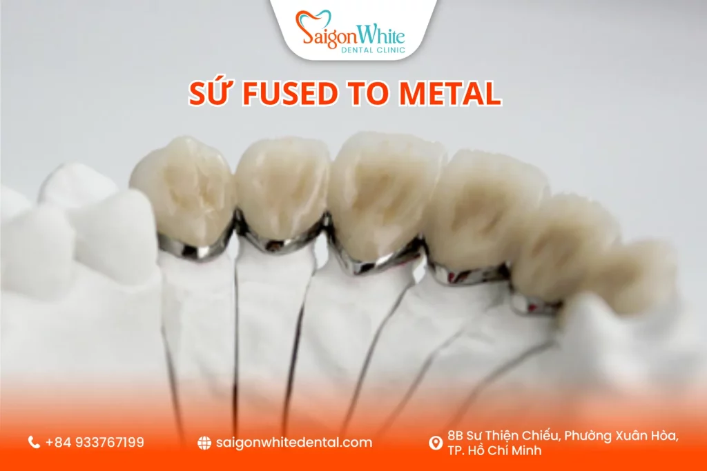 Sứ Fused to Metal (PFM) cải tiến