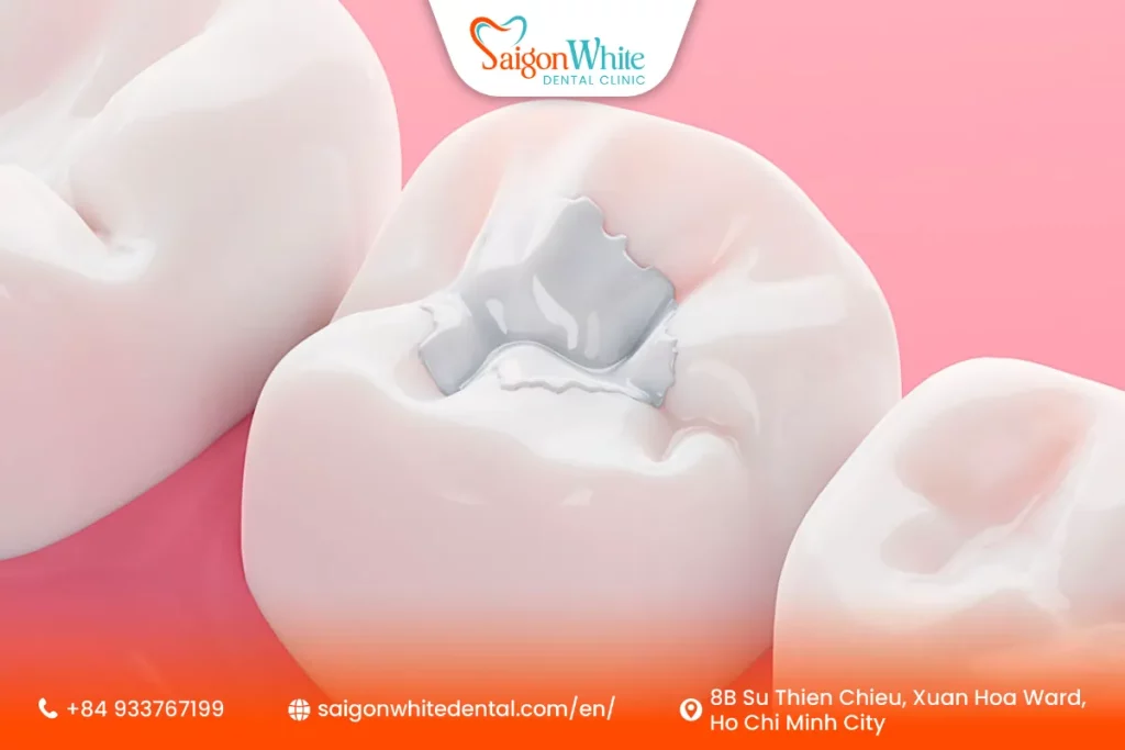 Types of Tooth Fillings Available in Ho Chi Minh City