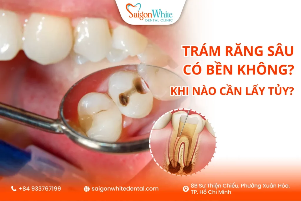 Trám răng sâu có bền không? Khi nào cần lấy tủy?