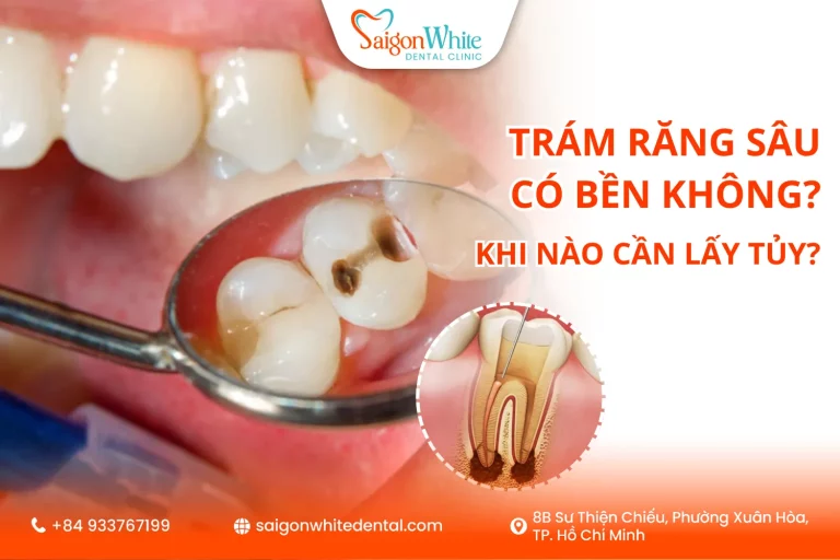Trám răng sâu có bền không? Khi nào cần lấy tủy?