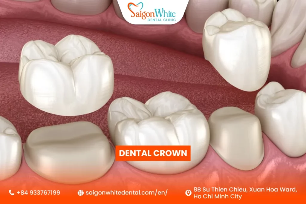 What Is a Dental Crown?