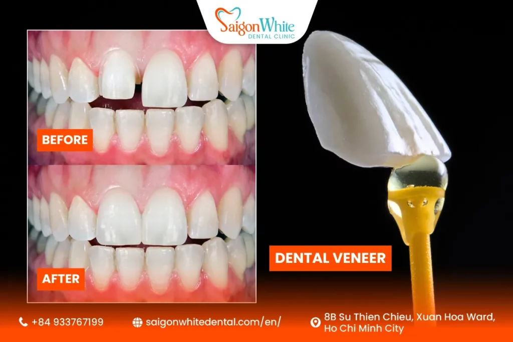 What Is a Veneer?