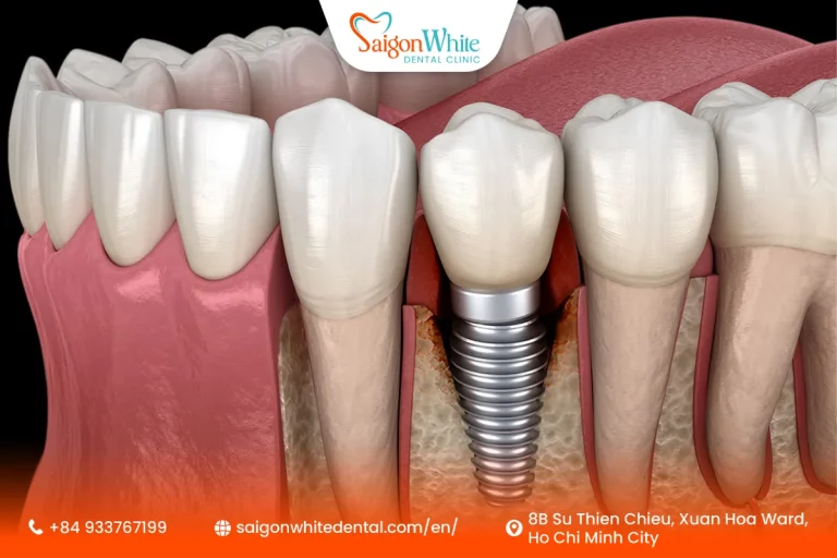 How to handle a loose dental implant