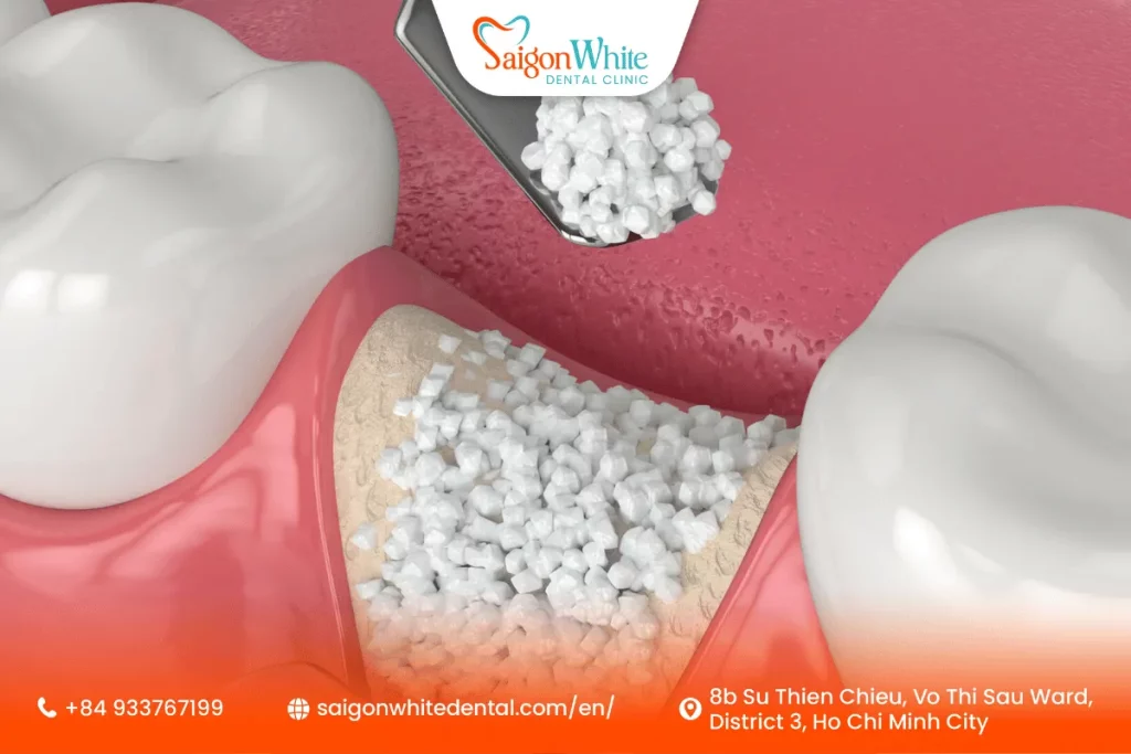 Why a Dental Bone Graft Might Be Necessary