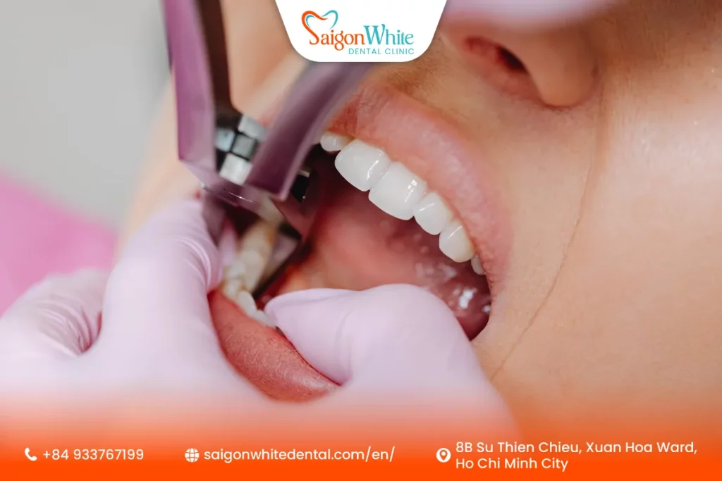 Step-by-Step Wisdom Tooth Removal Procedure