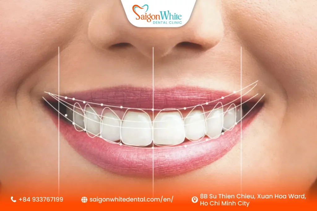 How Does a Hollywood Smile Makeover Work?