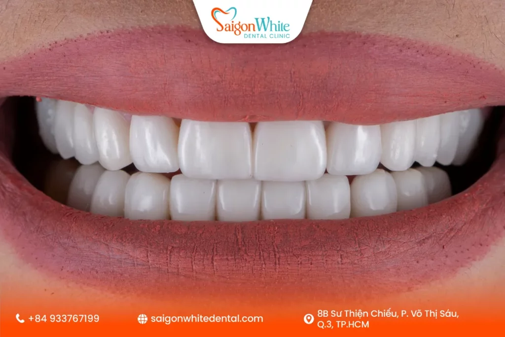 Lợi ích vượt trội khi bọc răng sứ thẩm mỹ
