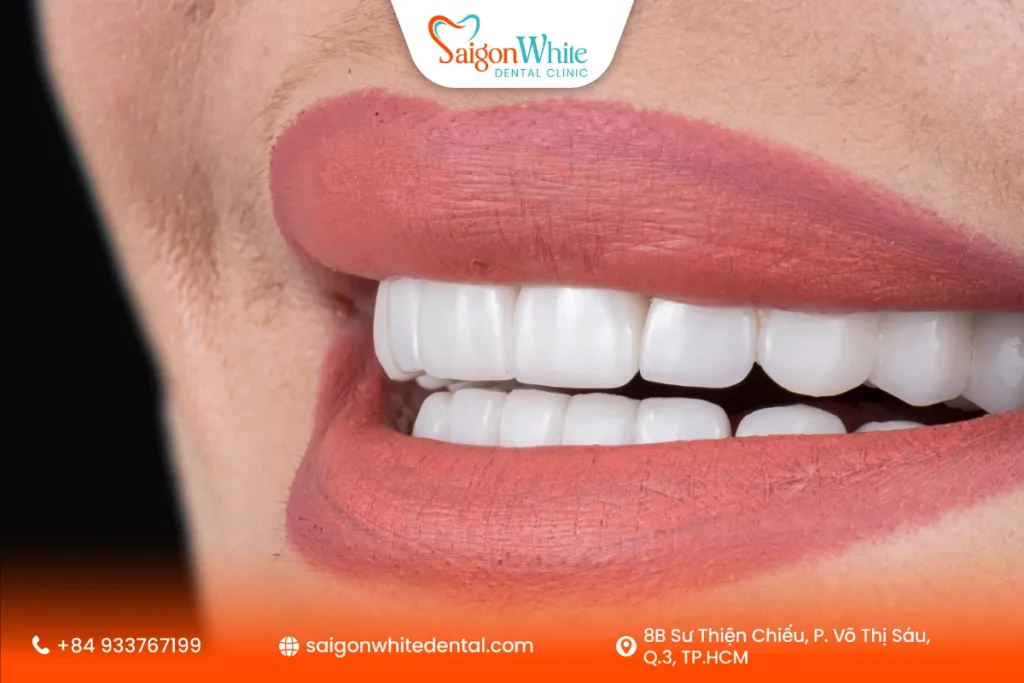 Bọc răng sứ là gì ?