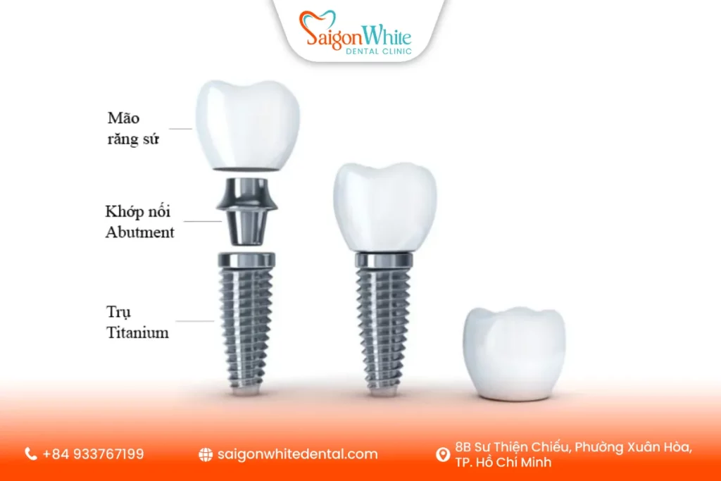 Cấu tạo của mão răng sứ gắn trong phục hình răng Implant