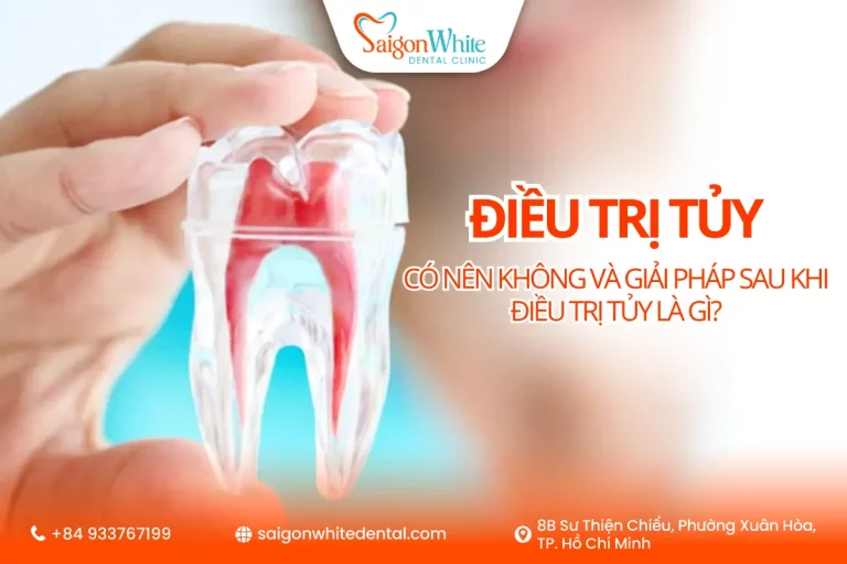 Có nên điều trị tủy không? Giải pháp sau khi điều trị tủy là gì?