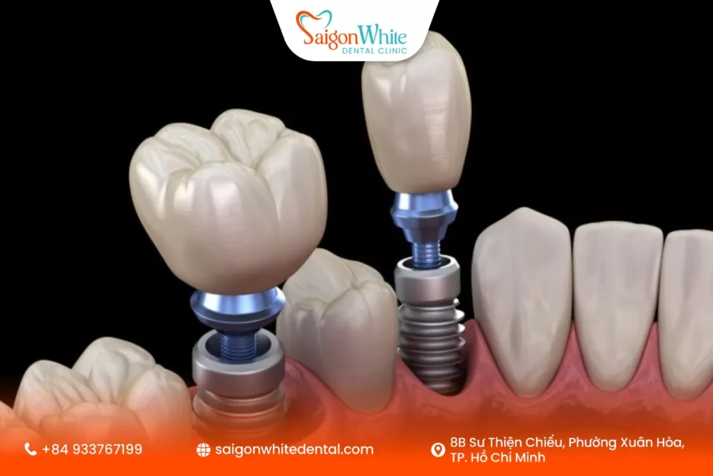 Độ bền của mão sứ trên implant