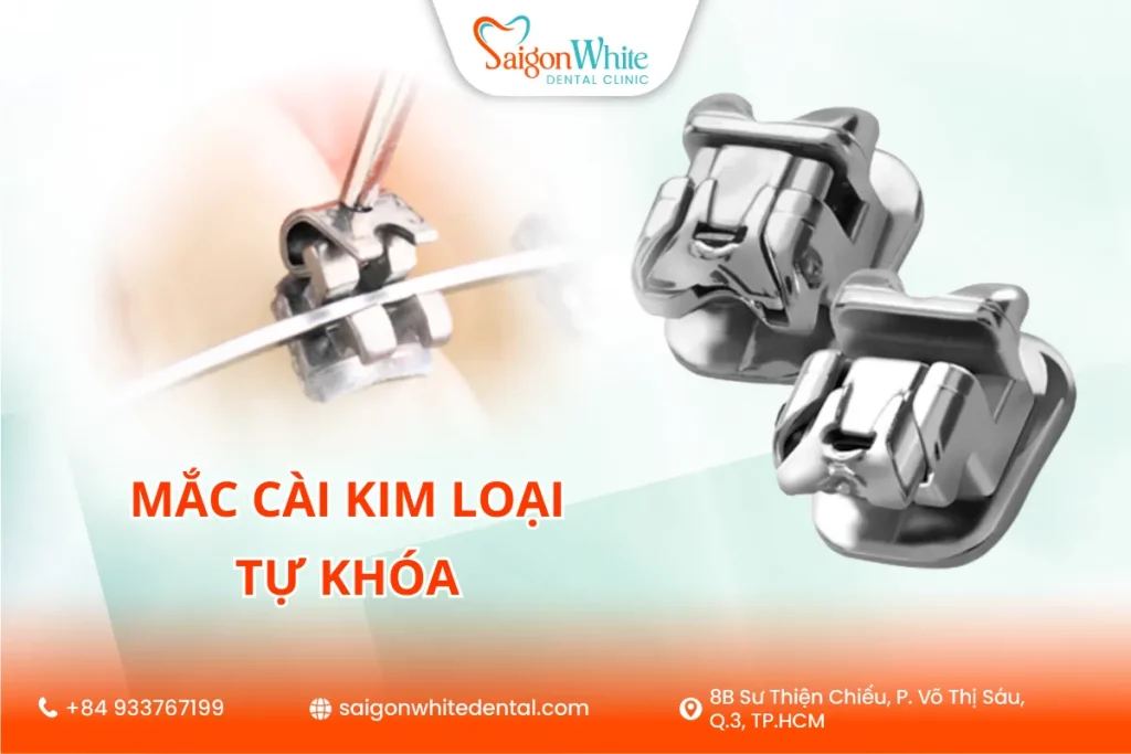 Niềng răng mắc cài kim loại tự khóa