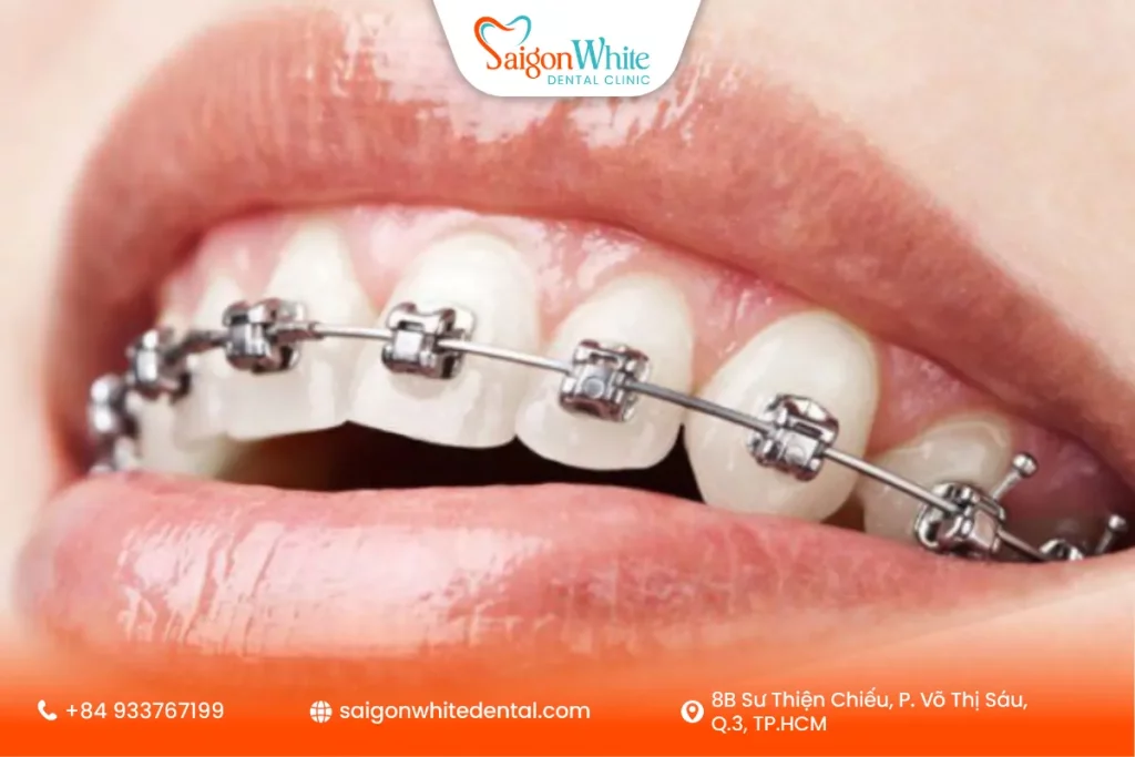 Niềng răng mắc cài kim loại tự khóa là gì?