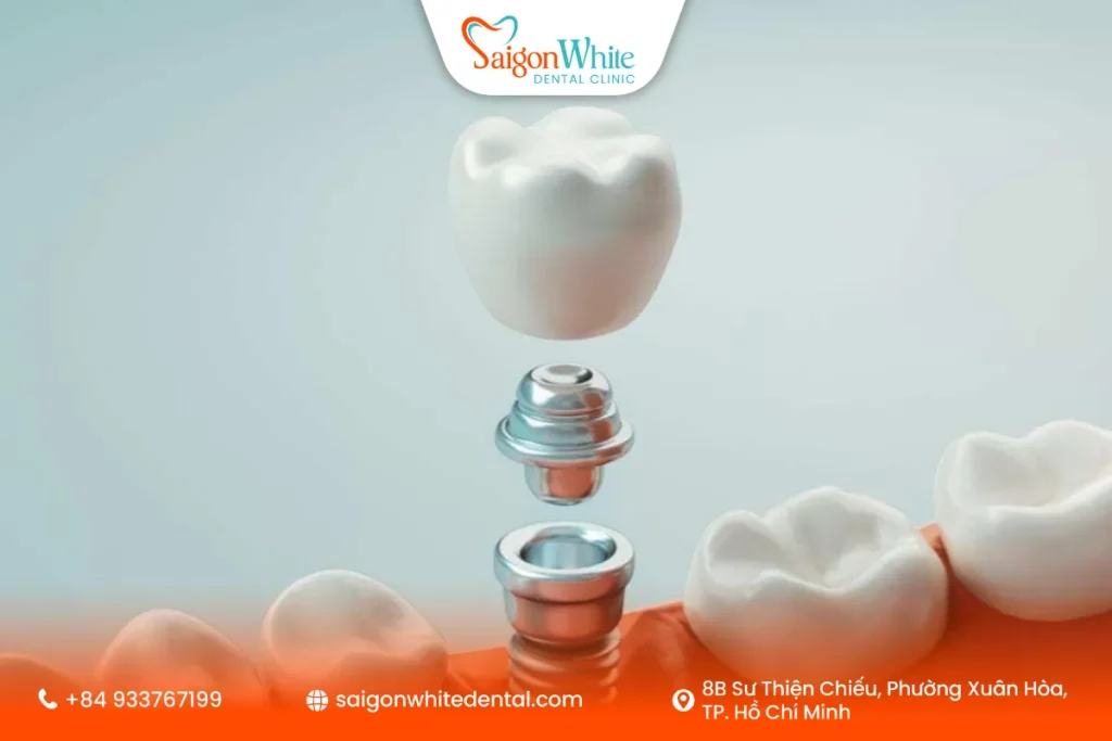 Mão răng sứ là gì trong phục hình răng Implant?