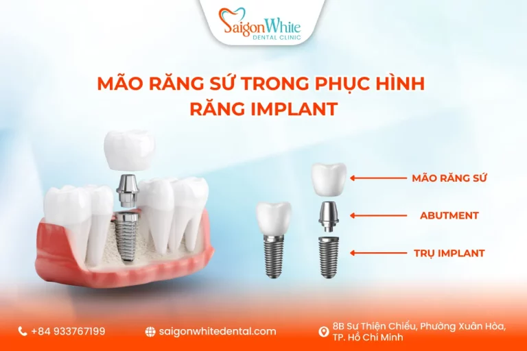 Mão răng sứ trong phục hình răng Implant