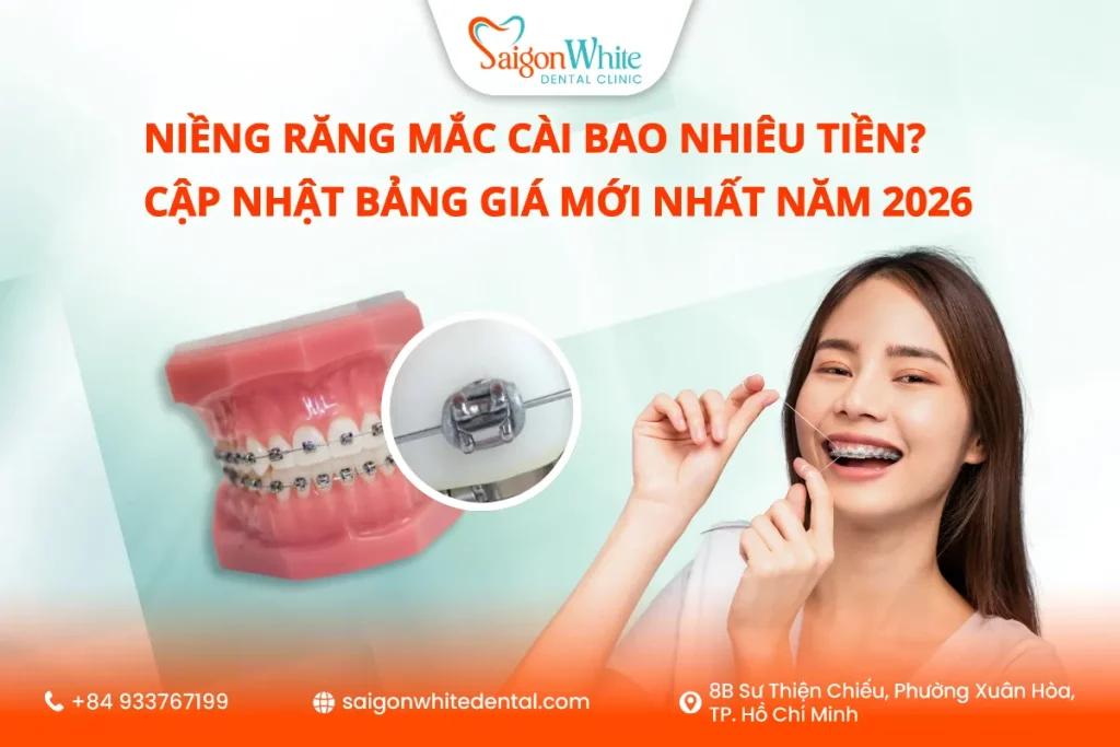 Chi phí niềng răng mắc cài bao nhiêu? Bảng giá năm 2026