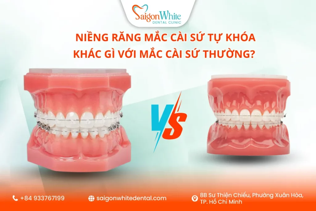 Niềng răng mắc cài sứ tự khóa và mắc cài sứ thường