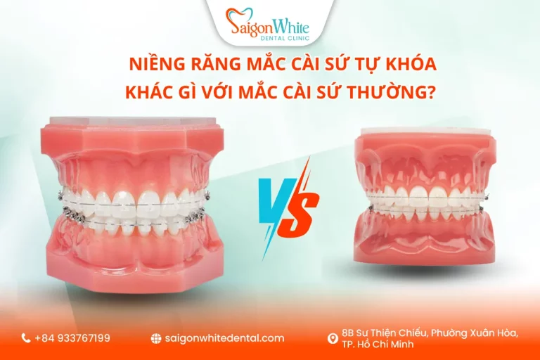 Niềng răng mắc cài sứ tự khóa và mắc cài sứ thường
