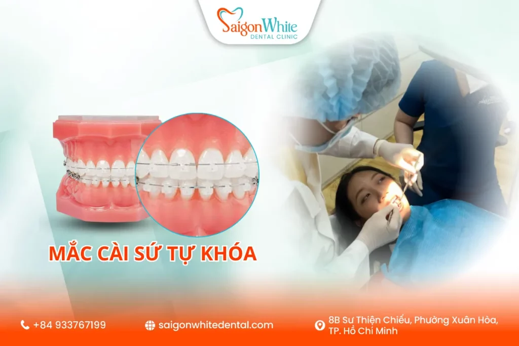 Niềng răng mắc cài sứ tự khóa là gì