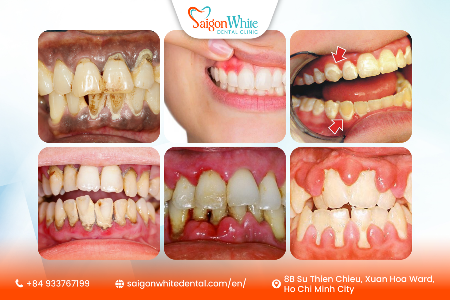 Rotting Gums Periodontitis (Gum Disease) Treatment in Ho Chi Minh City, Vietnam ...
