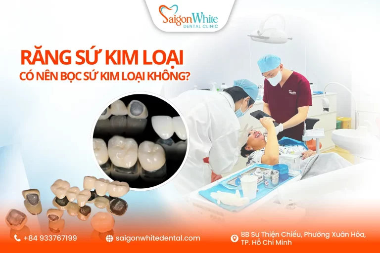 Răng sứ kim loại là gì? Có nên bọc sứ kim loại không?