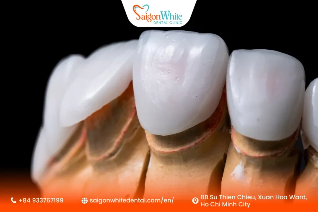 How Much Is the Cost of Porcelain Veneers in Vietnam