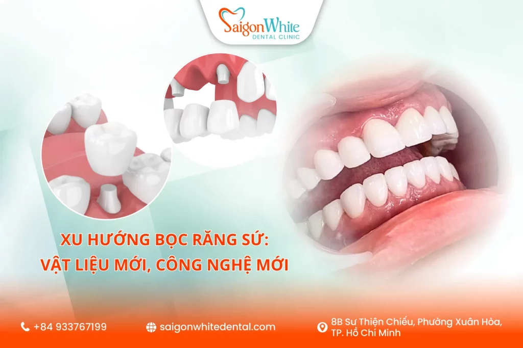Xu Hướng Bọc Răng Sứ 2025: Vật Liệu Mới, Công Nghệ Mới