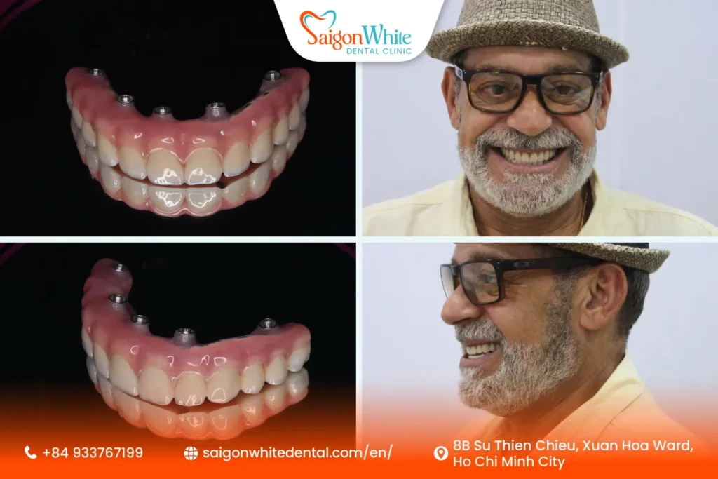 An international patient makes a full-mouth Dental Implant at Saigon White Dental in Vietnam.