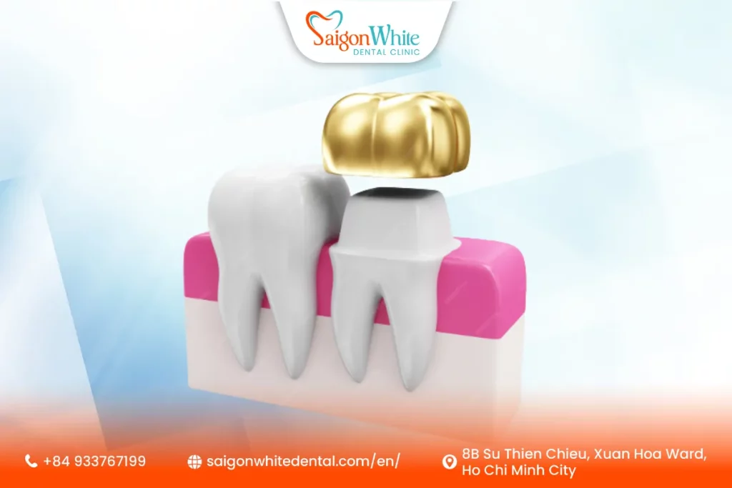 What Is a Gold Tooth Crown?