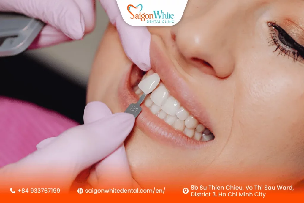 Dental Veneer