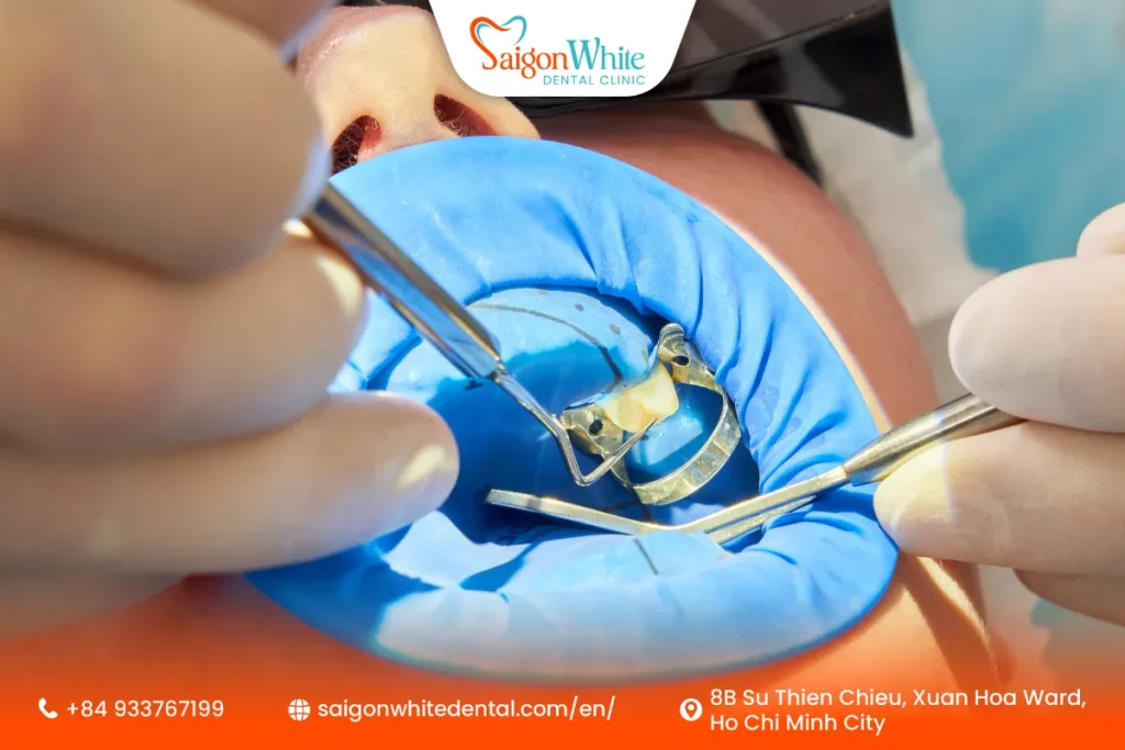 Dental fillings with composite materials