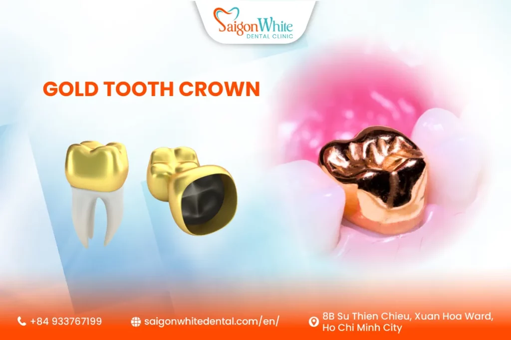 Gold Tooth Crown In Ho Chi Minh, Vietnam