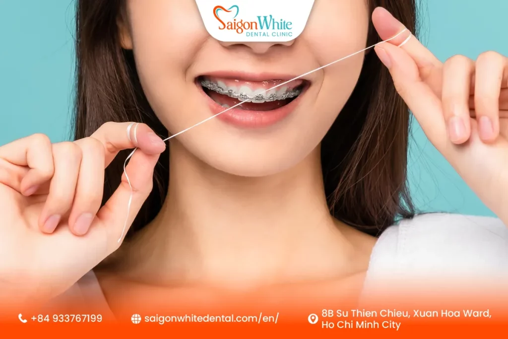 Types of Braces Available in Vietnam